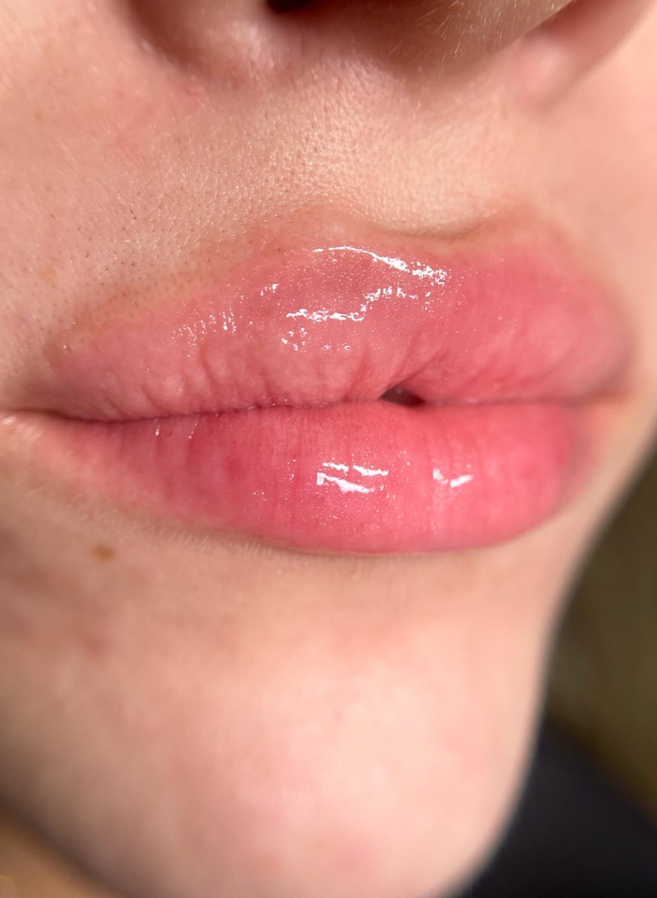 Hydra Lips